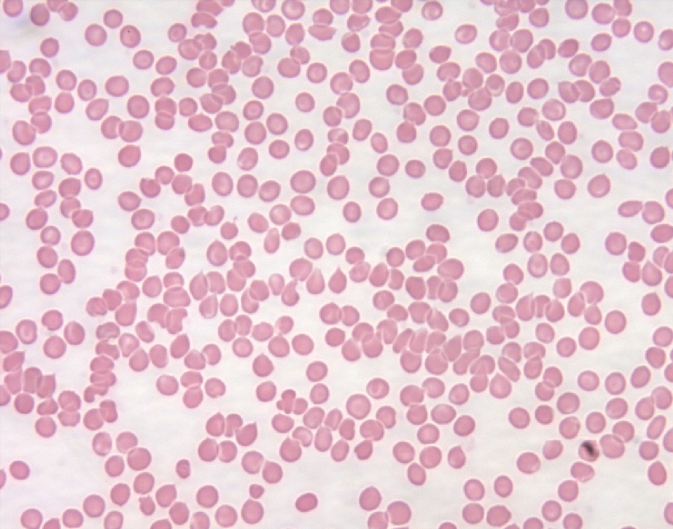 Hematology Of Leukemia Hematology Of Leukemia
